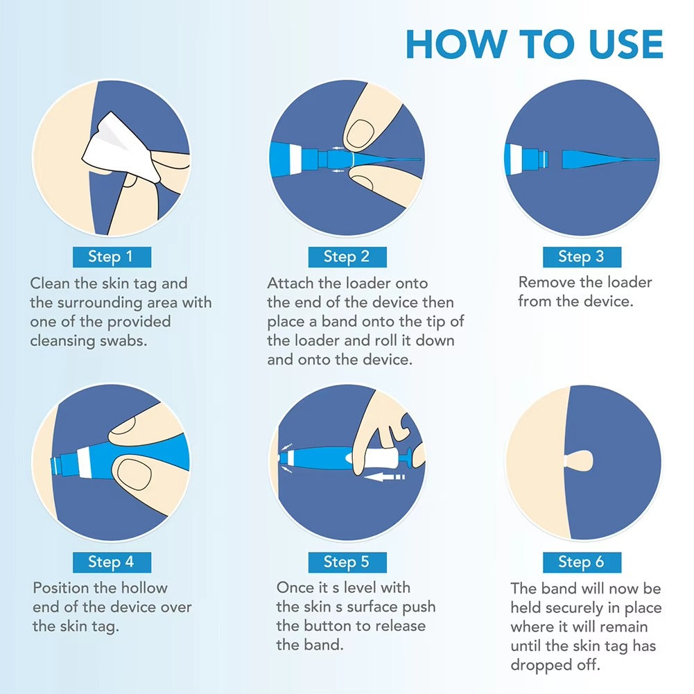 AUTO SKIN TAG REMOVER KIT